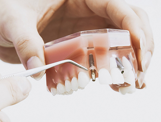 implante, implante dental, dentista, salud, lima, dentista surco
