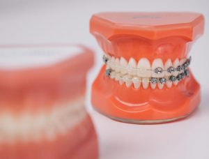 ortodoncia, brackets, enderezar dientes, mejorar sonrisa, invisalign, ortodoncia invisible, ortodoncia estetica, ortodoncia lingual, clínica dental, dentistas lima, dentista lima, dentistas surco, dentista surco, clinica dental surco