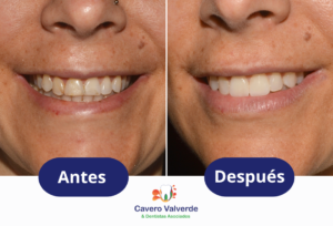 carillas, carillas dentales, dentista lima, dentista surco, lima peru, mejorar sonrisa