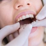 invisalign, ortodoncia, ortodoncia invisible, dentista, Dental, clínica dentales, clínica dental, clínicas dentales, clinic dent, clínica dental, clínica odontológica, clínica odontología, clínicas dentales, estética dental, clinica odontogica, centro dental, diseño de sonrisa, sonrisa, clinica dental lima, carillas dentales, clinica dental en lima, clínicas dentales lima, carillas dentales precio peru, dentista lima, alineadores dentales, carillas de porcelana, ortodoncia lima, clínicas dentales en lima, carillas dentales precios, odontologo, odontologos, dentista, dentistas, ortodoncista, brackets, implantes dental, implantes dentales, carillas dentales, carilla dental, coronas, ortodoncia, ortodoncias