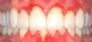 gingivitis, encia inflamada, encia roja, inflamación de encías, inflamacion de encias, inflamacion encias, sangrado encias, heridas en la encia, encia inflamada que tomar