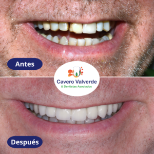 carillas, carillas dentales, dentista lima, dentista surco, lima peru, mejorar sonrisa, dr marco, dr cavero, doctor cavero, doctora mercedes, doctora valverde, odontologo en lima