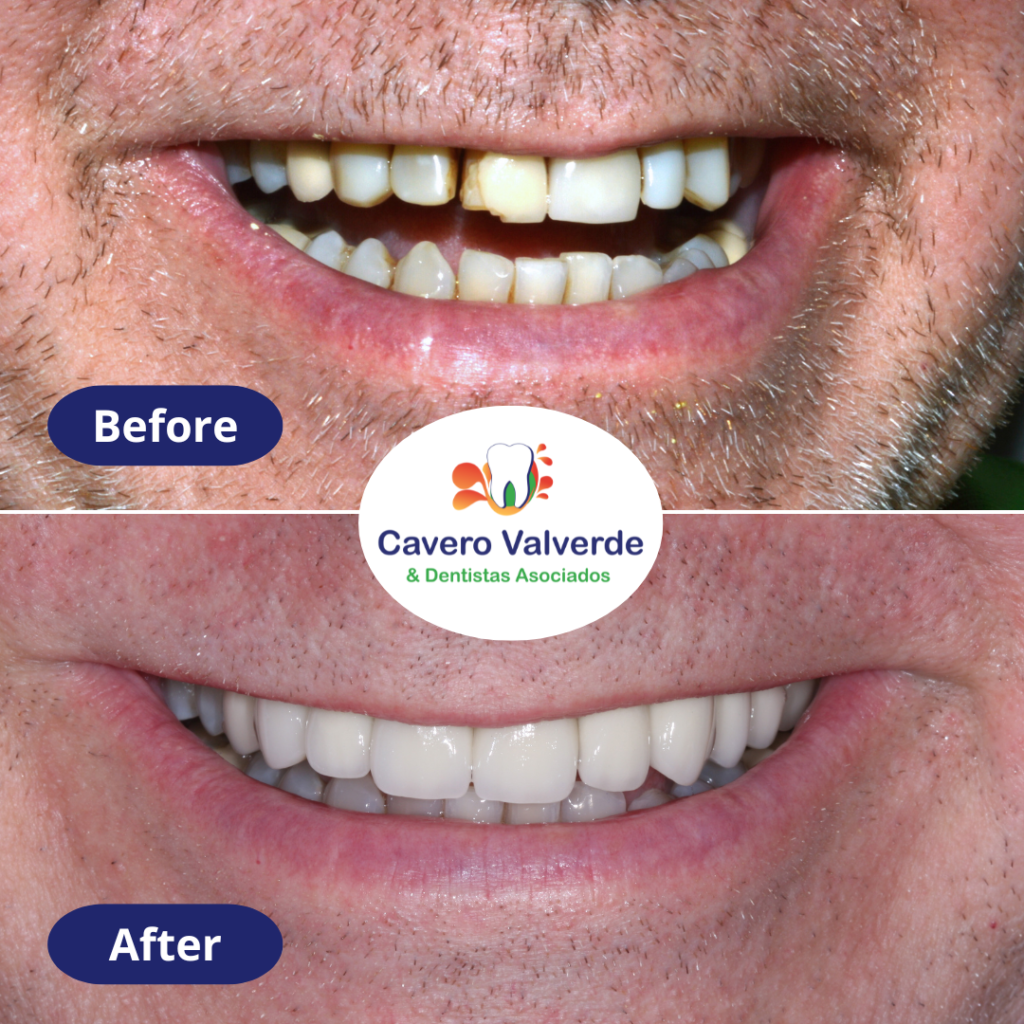Before and after dental treatment, before and after crown, testimonials dentist, testimonials. crowns