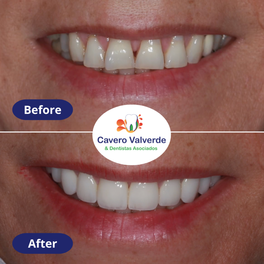 Before and after veneers, dentist lima, dentist miraflores,