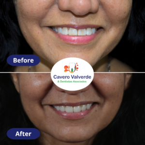 before and after veneers, before and after crowns, dental tourism mexico, dental tourism, dentist lima, dentist, best dentist lima, before and after braces