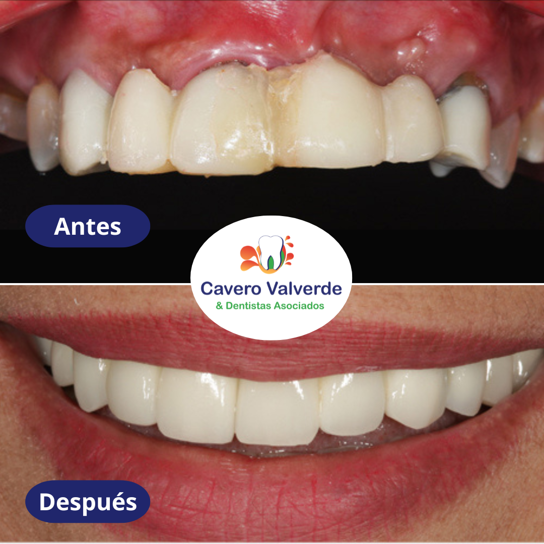Caso de antes y después de implante dental en nuestra clinica dental. Por especialista en implantes dentales.