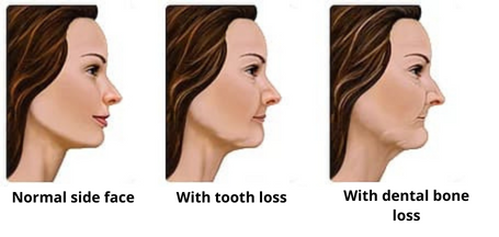 aging, dental bone loss process