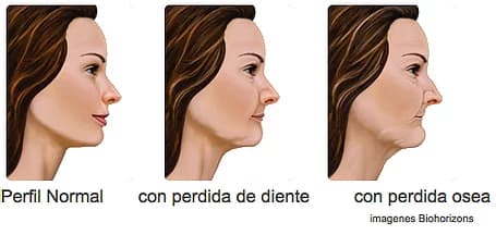Se muestran las tres etapas de la pérdida osea. La primera imagen es un perfil normal, la segunda se muestra con la pérdida de un diente y la tercera se muestra el perfil con pérdida ósea. rejuvenecimiento facial, rejuvenecimiento, arrugas, cuidado de la cara, joven, anti-aging, prevenir el envejecimiento